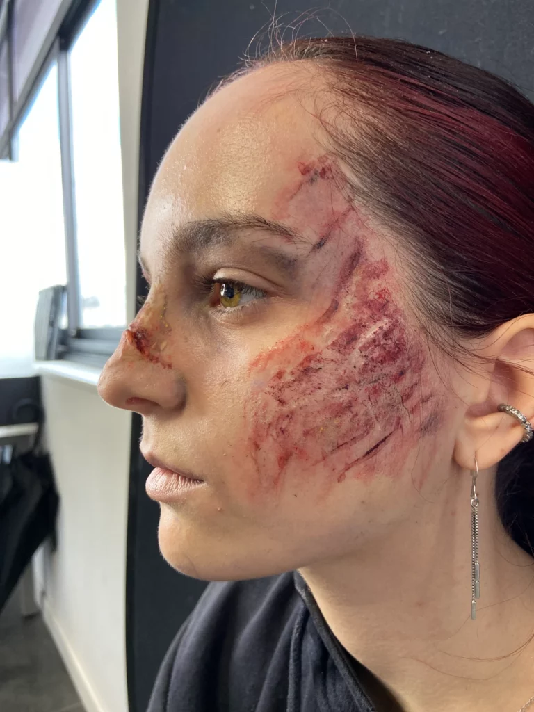 Une femme aux longs cheveux foncés de profil, arborant des égratignures et des ecchymoses sévères.